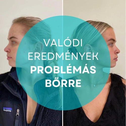 Valódi eredmények problémás bőrre 2 hónap alatt